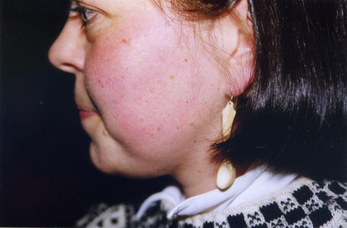 Selvfølgelig med grautskje i øret ;)